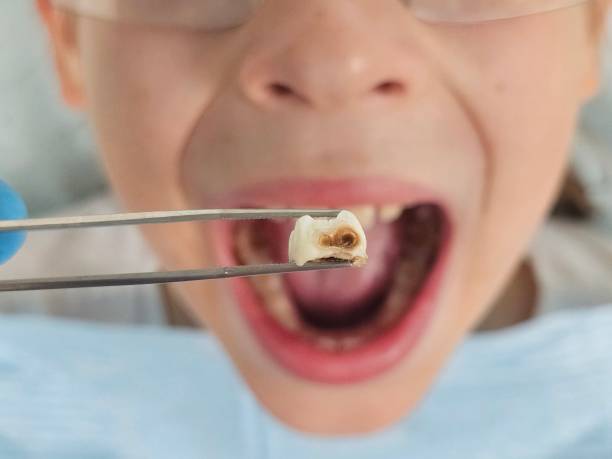 Best Dentist for Tooth Abscess  in Mansfield, LA